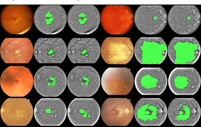 Figure 4 for A deep learning model for segmentation of geographic atrophy to study its long-term natural history