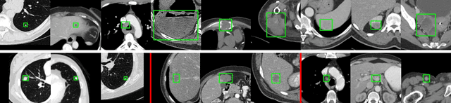 Figure 3 for Universal Lesion Detection by Learning from Multiple Heterogeneously Labeled Datasets