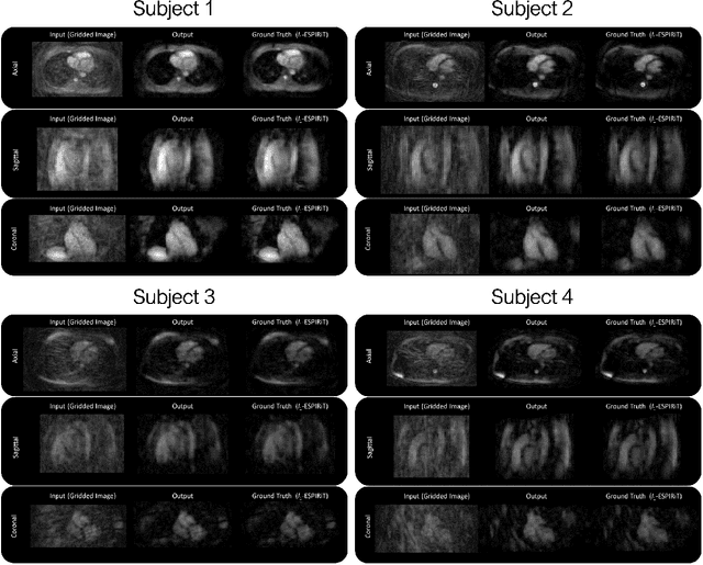 Figure 4 for Reconstruction of Undersampled 3D Non-Cartesian Image-Based Navigators for Coronary MRA Using an Unrolled Deep Learning Model