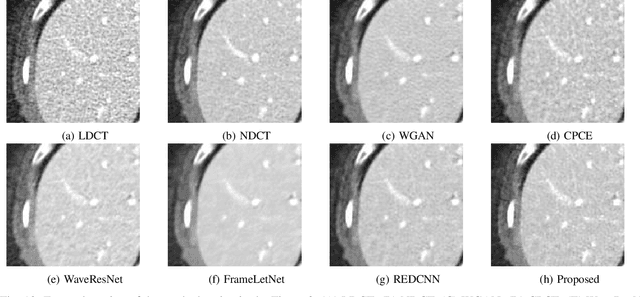 Figure 2 for Noise Conscious Training of Non Local Neural Network powered by Self Attentive Spectral Normalized Markovian Patch GAN for Low Dose CT Denoising