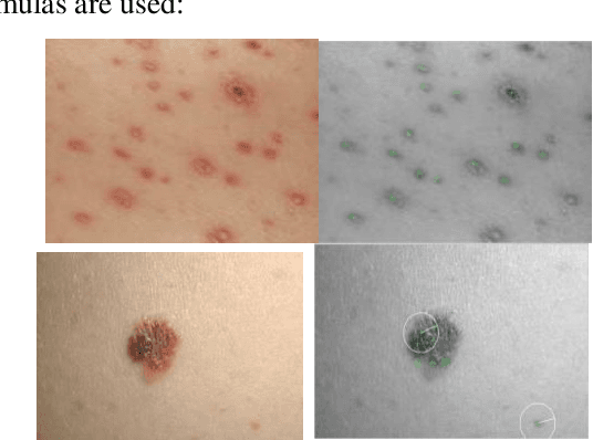 Figure 3 for A New Approach for Automatic Segmentation and Evaluation of Pigmentation Lesion by using Active Contour Model and Speeded Up Robust Features