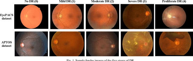 Figure 1 for Multitasking Deep Learning Model for Detection of Five Stages of Diabetic Retinopathy