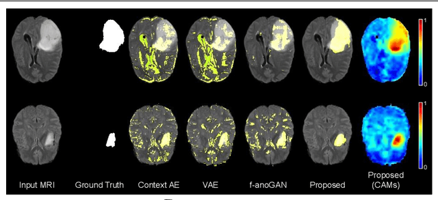 Figure 4 for Looking at the whole picture: constrained unsupervised anomaly segmentation