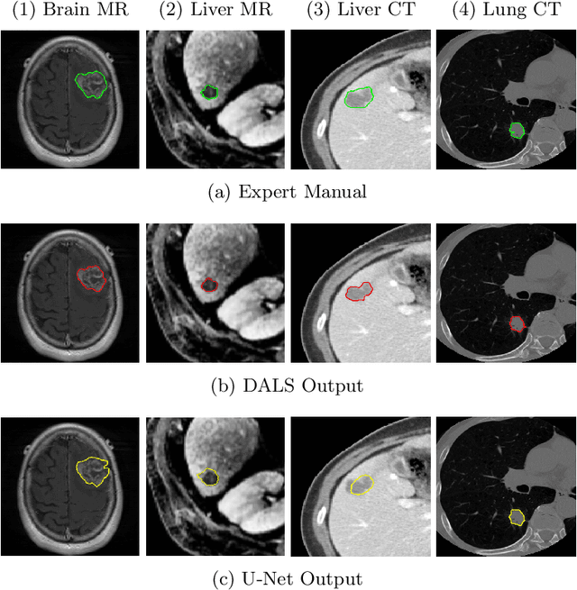 Figure 1 for Deep Active Lesion Segmentation