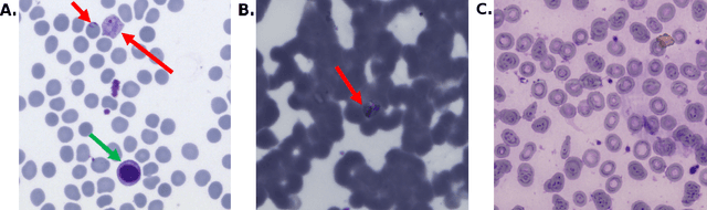 Figure 1 for Fully-automated patient-level malaria assessment on field-prepared thin blood film microscopy images, including Supplementary Information