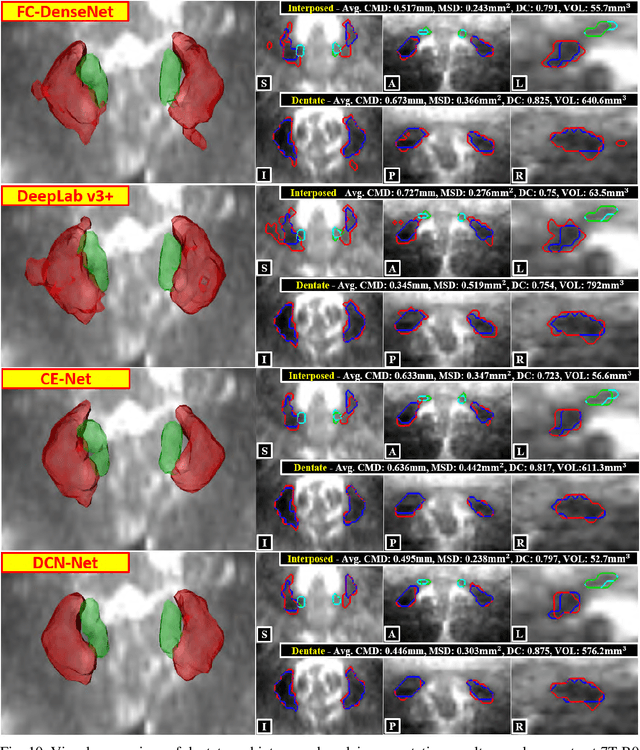 Figure 2 for Deep Cerebellar Nuclei Segmentation via Semi-Supervised Deep Context-Aware Learning from 7T Diffusion MRI