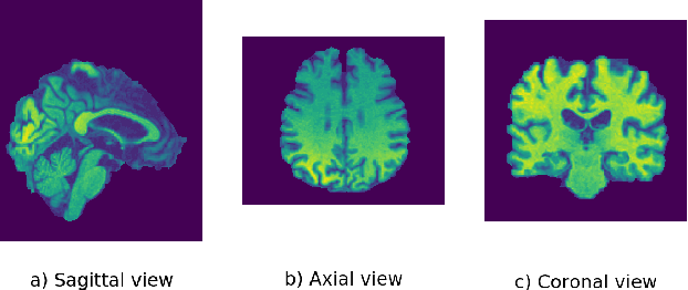 Figure 2 for An Explainable 3D Residual Self-Attention Deep Neural Network FOR Joint Atrophy Localization and Alzheimer's Disease Diagnosis using Structural MRI