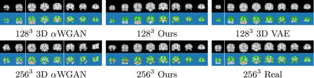 Figure 4 for Modelling the Distribution of 3D Brain MRI using a 2D Slice VAE