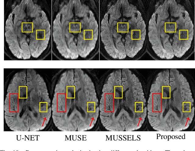 Figure 2 for Multi-Shot Sensitivity-Encoded Diffusion MRI using Model-Based Deep Learning (MODL-MUSSELS)