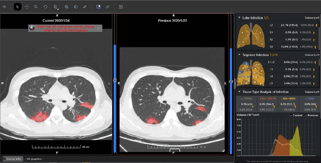 Figure 2 for Review of Artificial Intelligence Techniques in Imaging Data Acquisition, Segmentation and Diagnosis for COVID-19