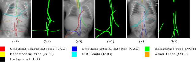 Figure 1 for Automatic catheter detection in pediatric X-ray images using a scale-recurrent network and synthetic data
