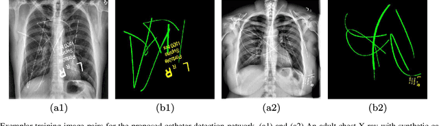 Figure 4 for Automatic catheter detection in pediatric X-ray images using a scale-recurrent network and synthetic data