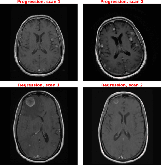 Figure 1 for Direct evaluation of progression or regression of disease burden in brain metastatic disease with Deep Neuroevolution