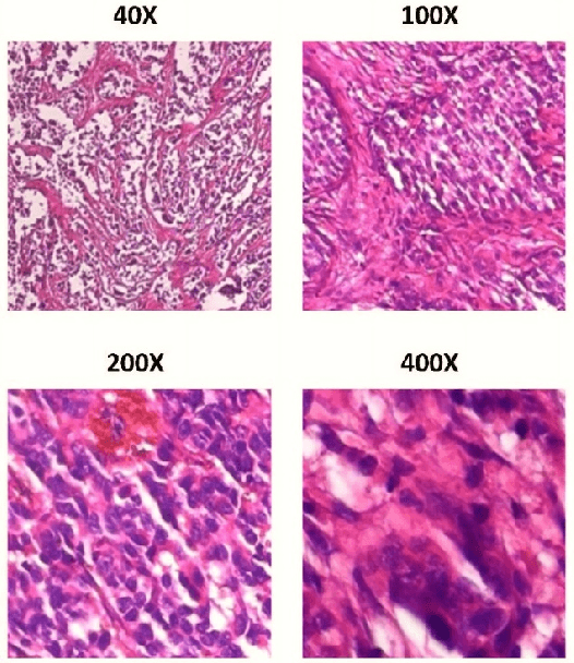 Figure 1 for Performance Comparison of Balanced and Unbalanced Cancer Datasets using Pre-Trained Convolutional Neural Network