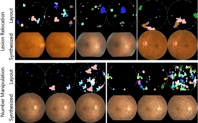 Figure 3 for Explainable Diabetic Retinopathy Detection and Retinal Image Generation