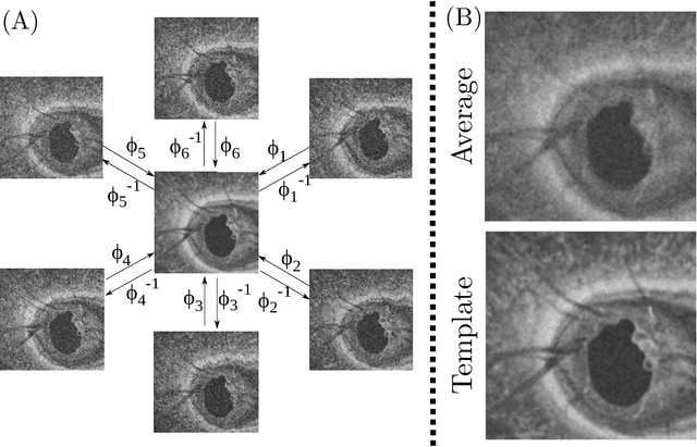 Figure 3 for Self-supervised Denoising via Diffeomorphic Template Estimation: Application to Optical Coherence Tomography