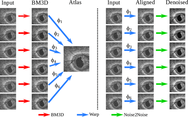 Figure 4 for Self-supervised Denoising via Diffeomorphic Template Estimation: Application to Optical Coherence Tomography