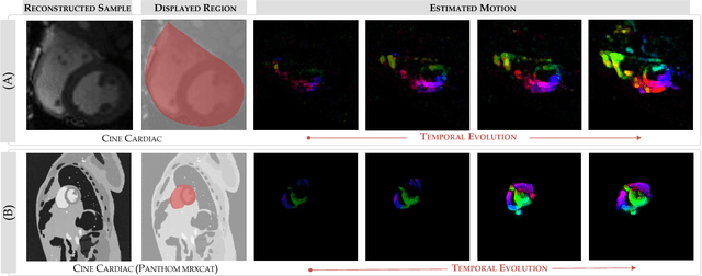 Figure 1 for Compressed Sensing Plus Motion (CS+M): A New Perspective for Improving Undersampled MR Image Reconstruction