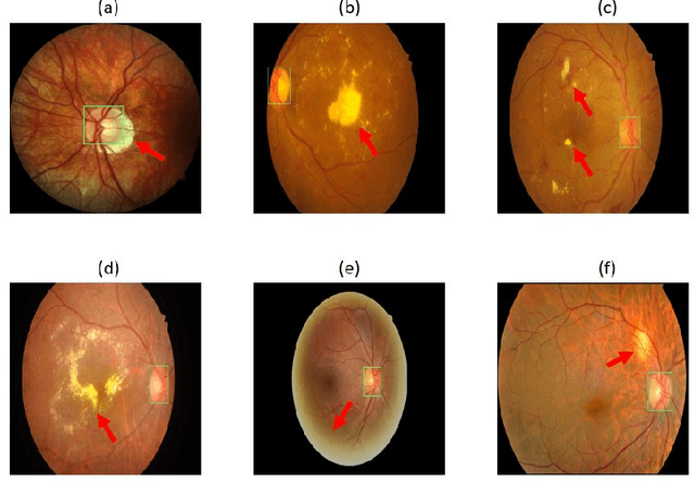 Figure 1 for Utilizing Transfer Learning and a Customized Loss Function for Optic Disc Segmentation from Retinal Images