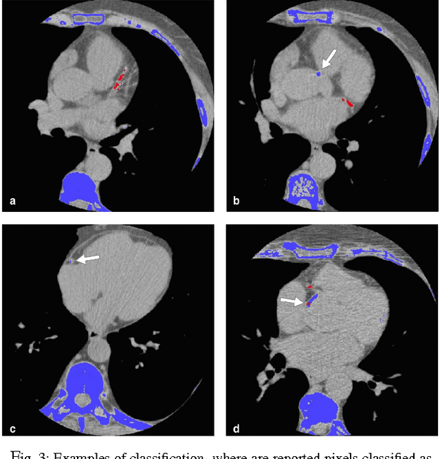 Figure 3 for An automatic deep learning approach for coronary artery calcium segmentation