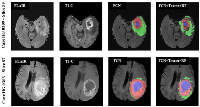 Figure 3 for Multimodal MRI brain tumor segmentation using random forests with features learned from fully convolutional neural network