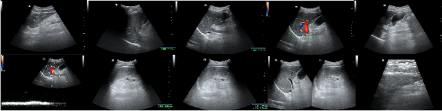 Figure 1 for Ultrasound Liver Fibrosis Diagnosis using Multi-indicator guided Deep Neural Networks