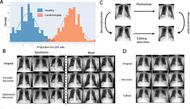 Figure 2 for Towards disease-aware image editing of chest X-rays