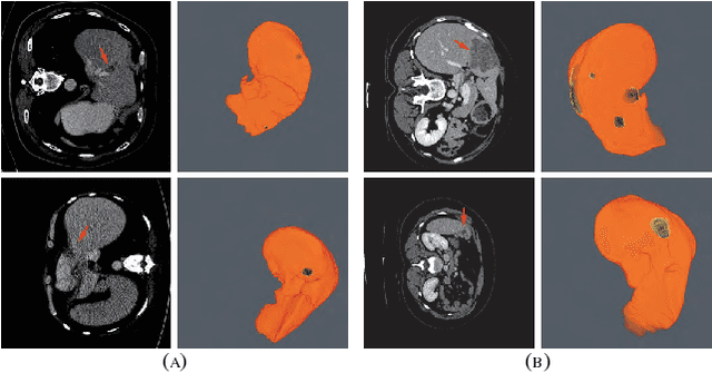 Figure 1 for RA-UNet: A hybrid deep attention-aware network to extract liver and tumor in CT scans