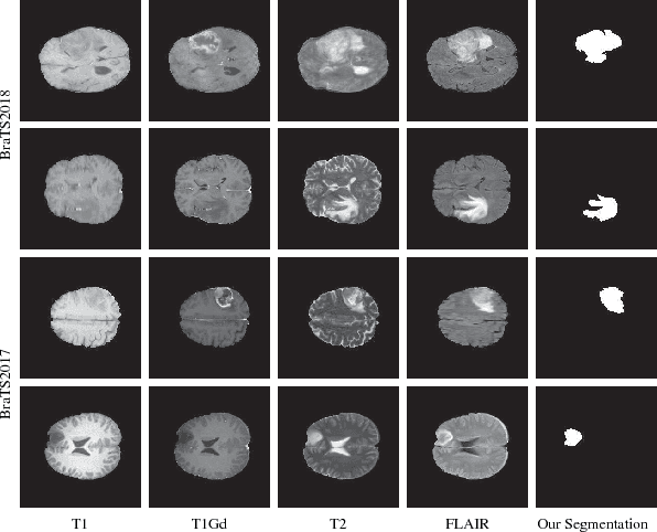 Figure 4 for RA-UNet: A hybrid deep attention-aware network to extract liver and tumor in CT scans