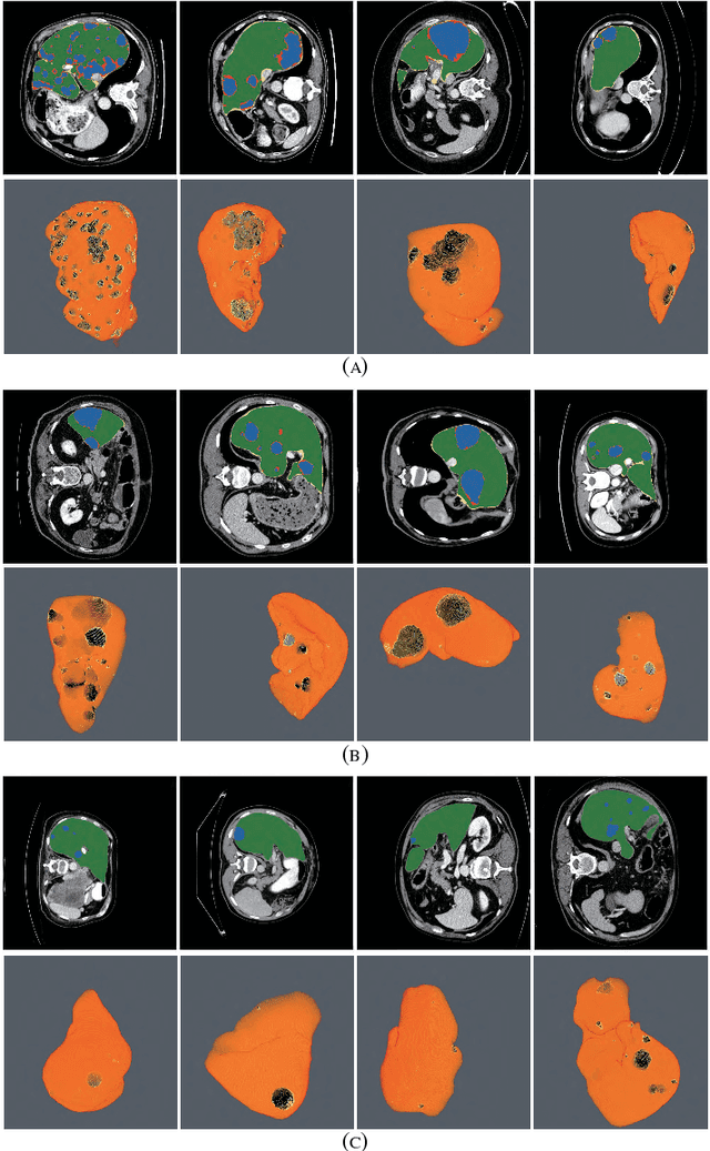 Figure 2 for RA-UNet: A hybrid deep attention-aware network to extract liver and tumor in CT scans