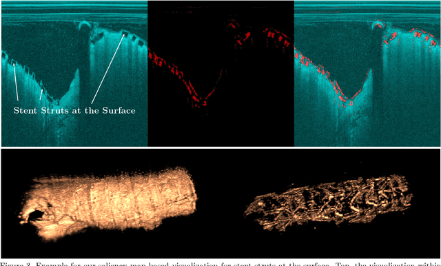 Figure 3 for Bioresorbable Scaffold Visualization in IVOCT Images Using CNNs and Weakly Supervised Localization