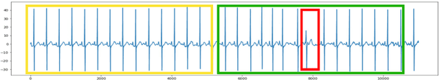 Figure 3 for Diagnosing Cardiac Abnormalities from 12-Lead Electrocardiograms Using Enhanced Deep Convolutional Neural Networks