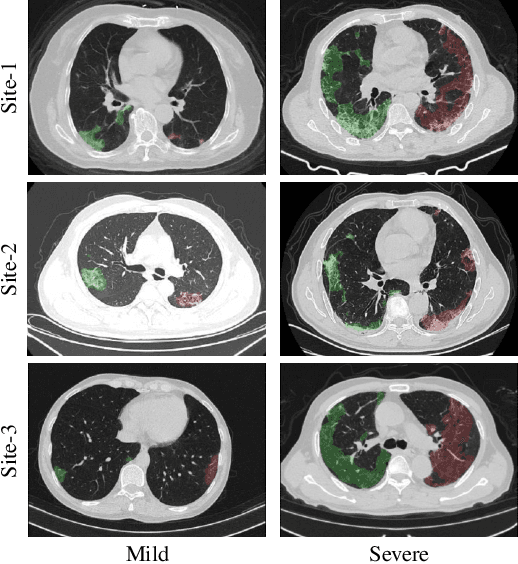 Figure 1 for Cross-Site Severity Assessment of COVID-19 from CT Images via Domain Adaptation