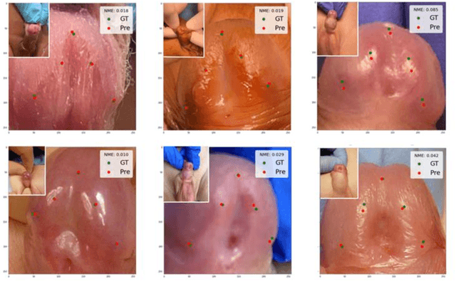 Figure 3 for Deep Learning based Automatic Quantification of Urethral Plate Quality using the Plate Objective Scoring Tool (POST)