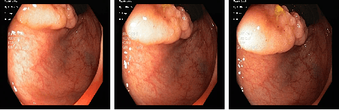 Figure 1 for In Defense of Kalman Filtering for Polyp Tracking from Colonoscopy Videos