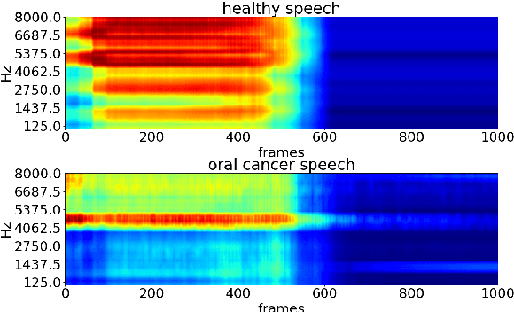 Figure 2 for Detecting and analysing spontaneous oral cancer speech in the wild
