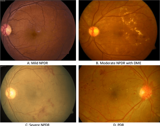 Figure 1 for Automated Detection and Diagnosis of Diabetic Retinopathy: A Comprehensive Survey