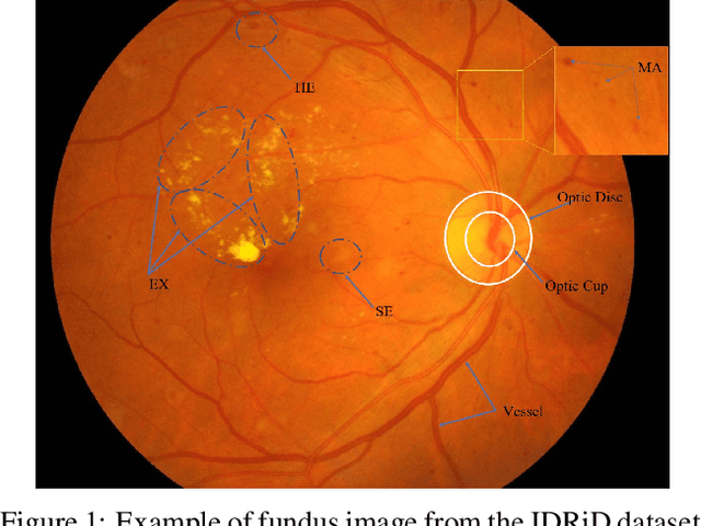 Figure 1 for Progressive Multi-scale Consistent Network for Multi-class Fundus Lesion Segmentation