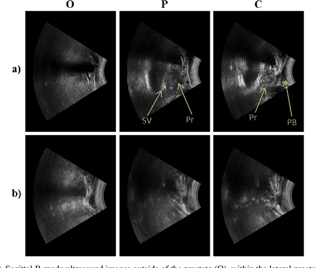 Figure 3 for Assisted Probe Positioning for Ultrasound Guided Radiotherapy Using Image Sequence Classification