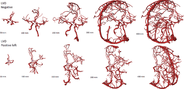 Figure 4 for An Algorithm for the Labeling and Interactive Visualization of the Cerebrovascular System of Ischemic Strokes