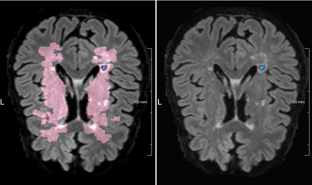 Figure 4 for MixLacune: Segmentation of lacunes of presumed vascular origin