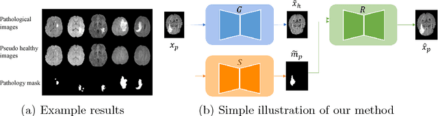 Figure 1 for Adversarial Pseudo Healthy Synthesis Needs Pathology Factorization
