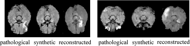 Figure 3 for Adversarial Pseudo Healthy Synthesis Needs Pathology Factorization