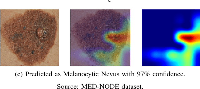Figure 4 for Skin Lesions Classification Using Convolutional Neural Networks in Clinical Images