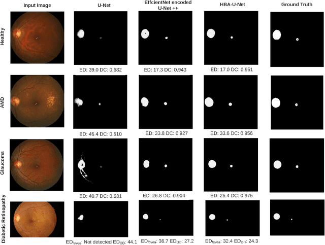 Figure 4 for U-Net with Hierarchical Bottleneck Attention for Landmark Detection in Fundus Images of the Degenerated Retina