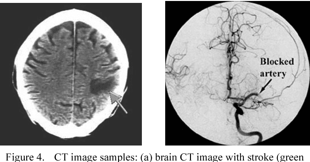 Figure 4 for CT Image Registration in Acute Stroke Monitoring