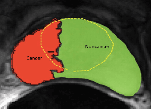 Figure 2 for Multi-resolution Super Learner for Voxel-wise Classification of Prostate Cancer Using Multi-parametric MRI