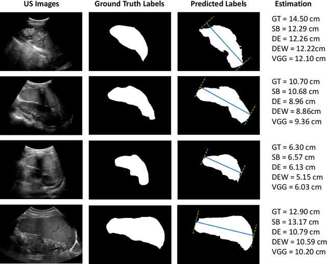 Figure 3 for Deep Learning for Automatic Spleen Length Measurement in Sickle Cell Disease Patients