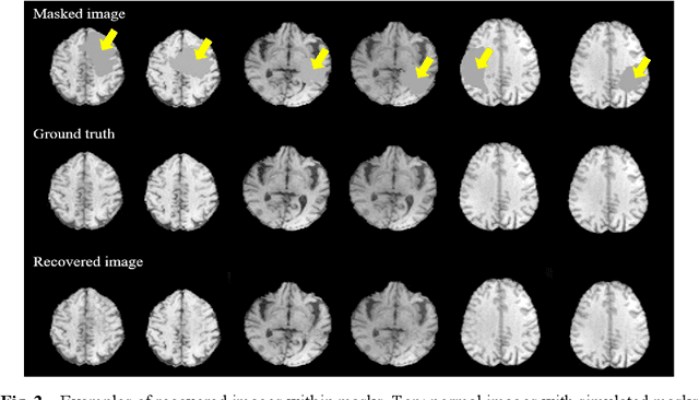 Figure 3 for Automatic Segmentation of Non-Tumor Tissues in Glioma MR Brain Images Using Deformable Registration with Partial Convolutional Networks