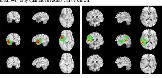 Figure 4 for Automatic Segmentation of Non-Tumor Tissues in Glioma MR Brain Images Using Deformable Registration with Partial Convolutional Networks